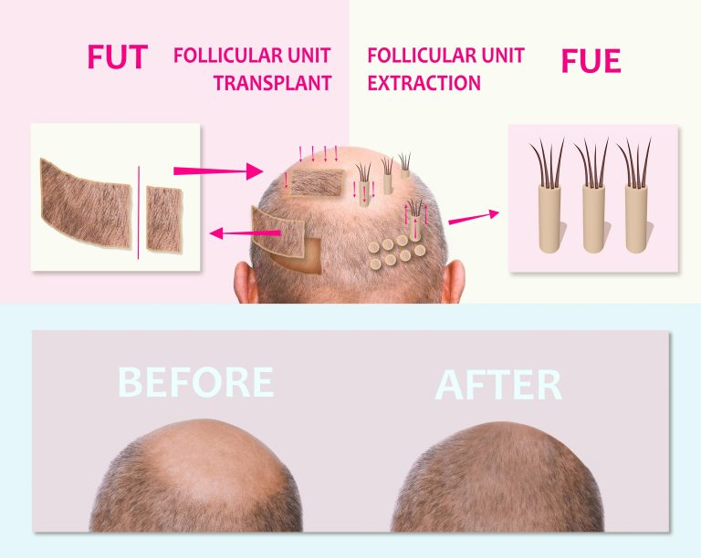 DHI Hair Transplant